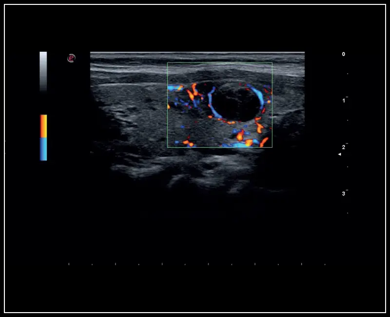 MyLab ™ Sigma - Klinik Görüntü: Tiroid lezyonu, Renkli Doppler ile 2D görüntüleme