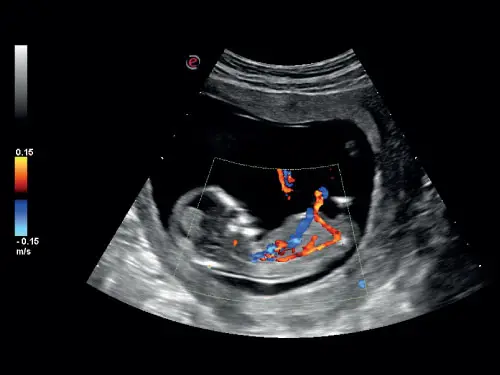 MyLab ™ Six - Fetus (B + CFM Görüntüleme)